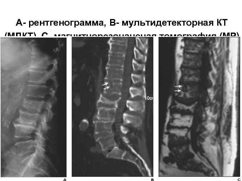 А- рентгенограмма, В- мультидетекторная КТ (МДКТ), С- магнитнорезонансная томография (МР) 