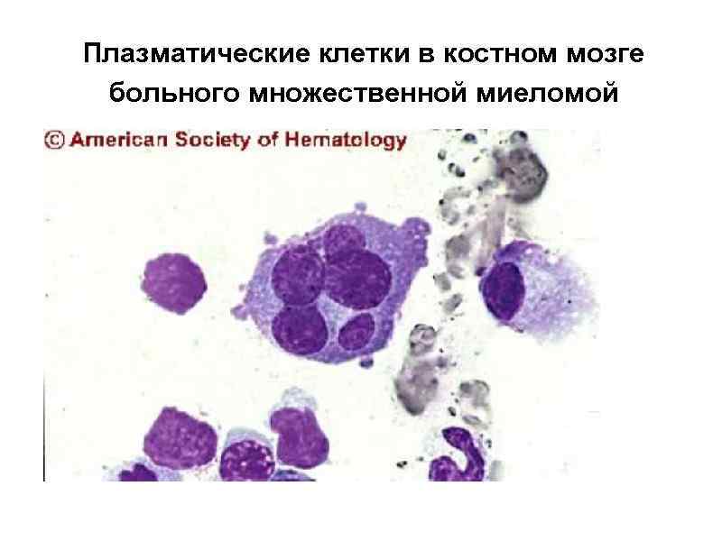 Плазматические клетки в костном мозге больного множественной миеломой 