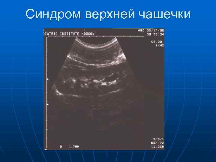 Синдром верхней чашечки 