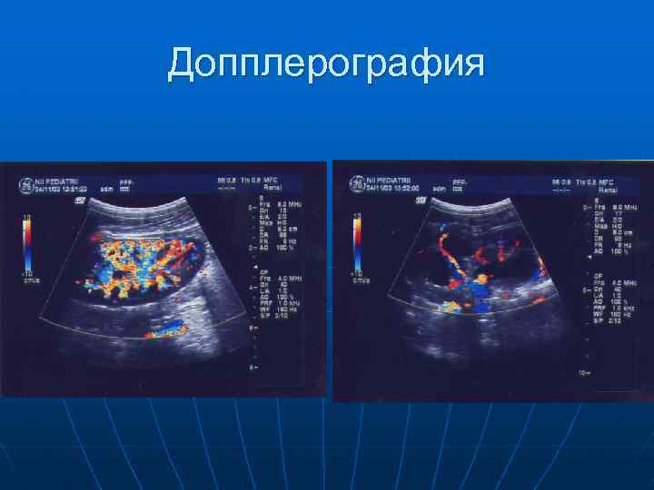 Допплерография 