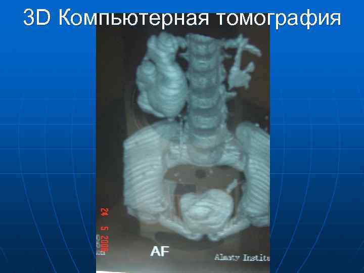 3 D Компьютерная томография 
