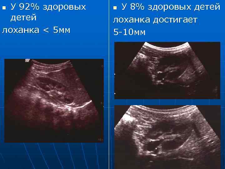 У 92% здоровых детей лоханка < 5 мм n У 8% здоровых детей лоханка