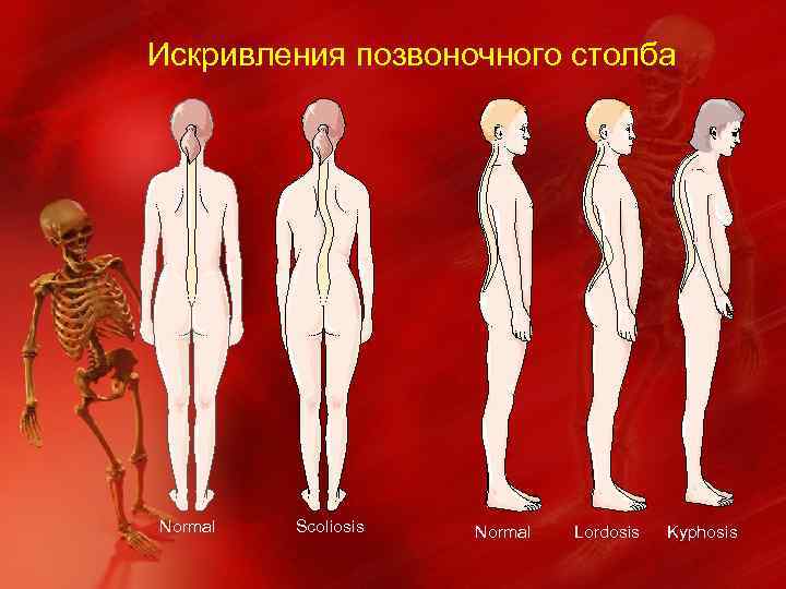 Искривления позвоночного столба Normal Scoliosis Normal Lordosis Kyphosis 