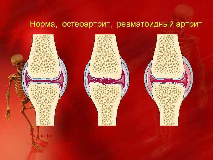 Норма, остеоартрит, ревматоидный артрит Normal joint Osteoarthritis Rheumatoid arthritis 