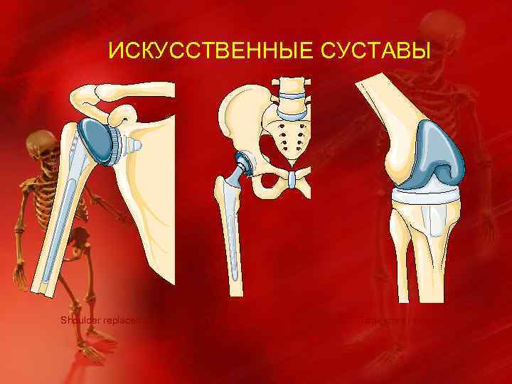 ИСКУССТВЕННЫЕ СУСТАВЫ Shoulder replacement Total hip replacement Total knee replacement 
