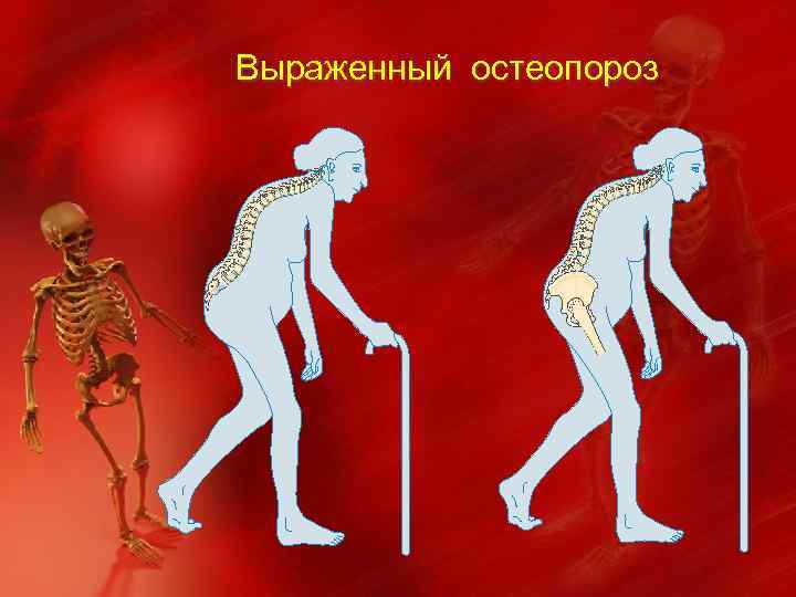 Выраженный остеопороз 