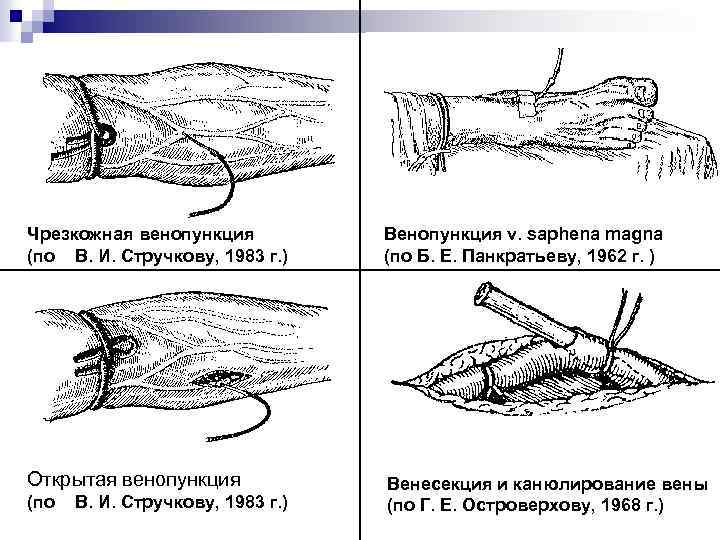 Чрезкожная венопункция (по В. И. Стручкову, 1983 г. ) Венопункция v. saphena magna (по