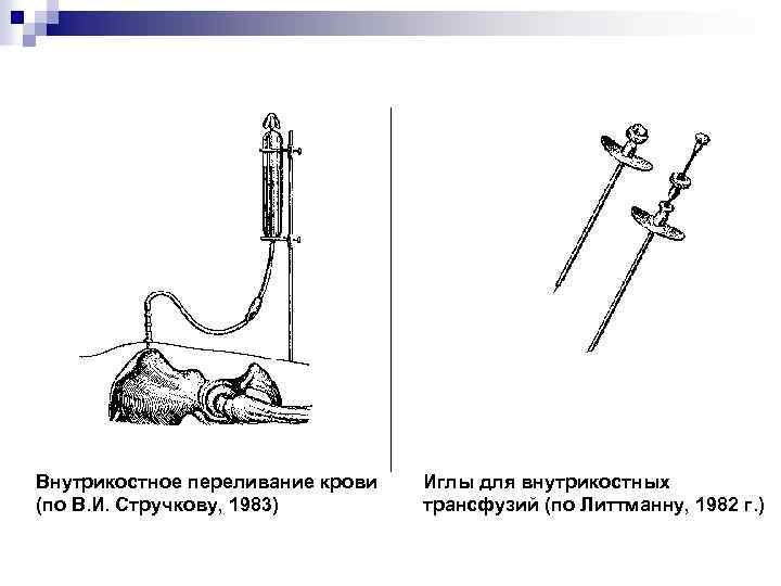 Внутрикостное переливание крови (по В. И. Стручкову, 1983) Иглы для внутрикостных трансфузий (по Литтманну,