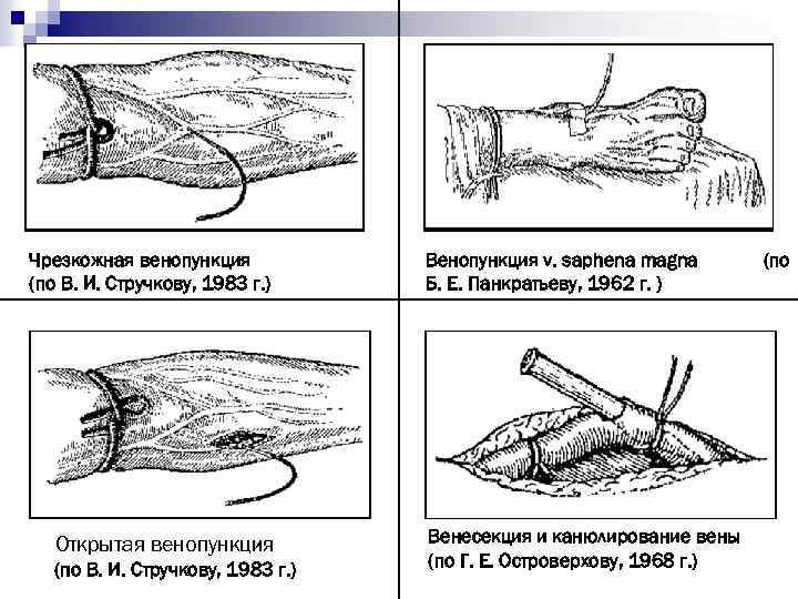 Чрезкожная венопункция (по В. И. Стручкову, 1983 г. ) Открытая венопункция (по В. И.