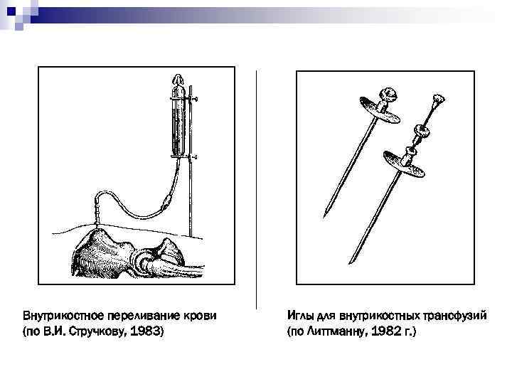 Внутрикостное переливание крови (по В. И. Стручкову, 1983) Иглы для внутрикостных трансфузий (по Литтманну,