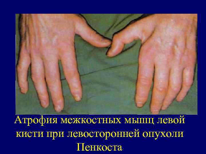 Атрофия межкостных мышц левой кисти при левосторонней опухоли Пенкоста 