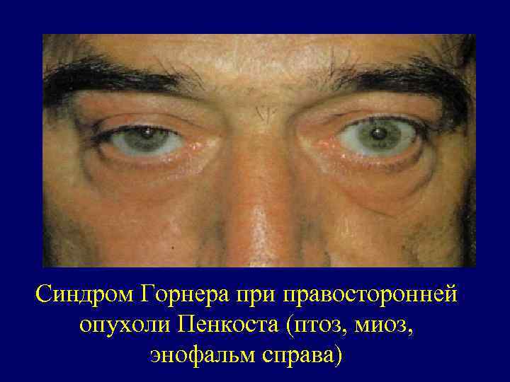 Синдром Горнера при правосторонней опухоли Пенкоста (птоз, миоз, энофальм справа) 