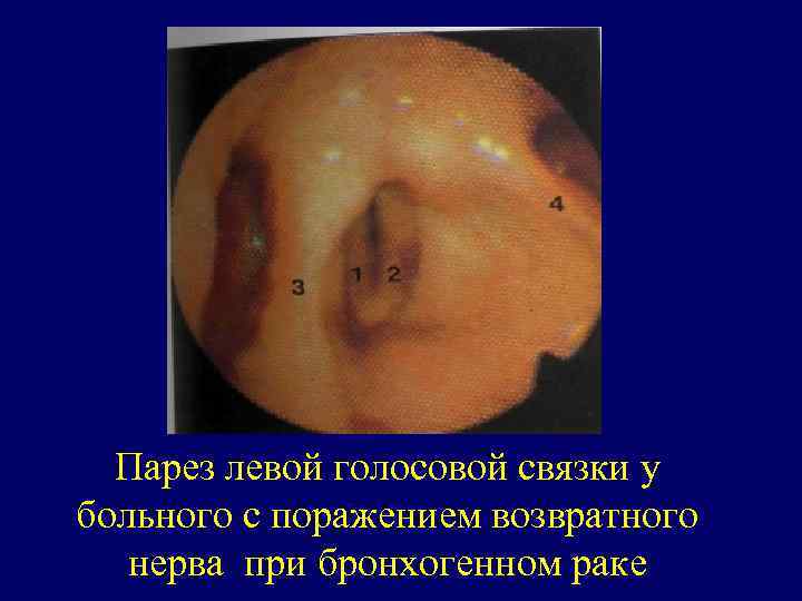 Парез левой голосовой связки у больного с поражением возвратного нерва при бронхогенном раке 