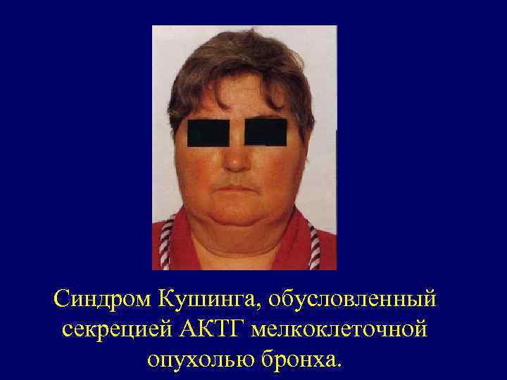 Синдром Кушинга, обусловленный секрецией АКТГ мелкоклеточной опухолью бронха. 