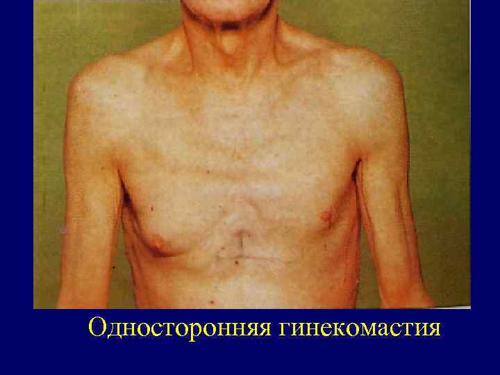 Односторонняя гинекомастия 