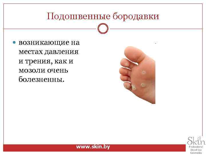 Подошвенные бородавки возникающие на местах давления и трения, как и мозоли очень болезненны. www.