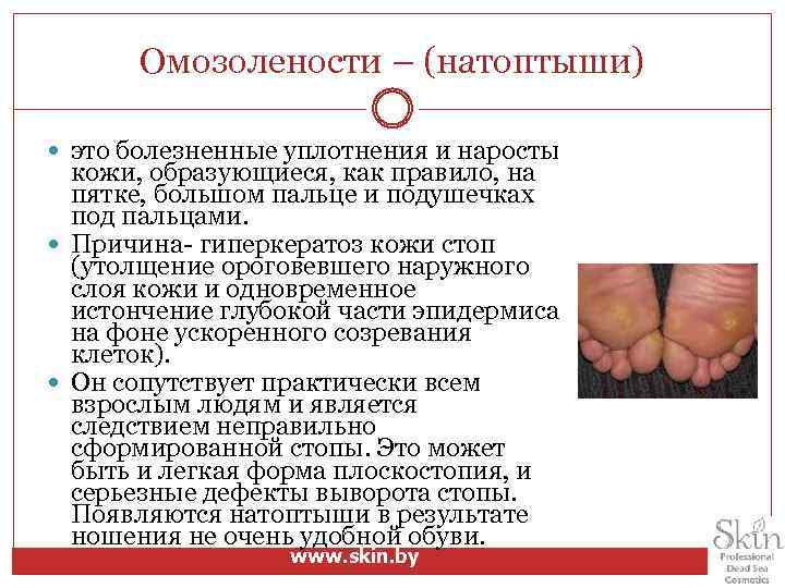 Омозолености – (натоптыши) это болезненные уплотнения и наросты кожи, образующиеся, как правило, на пятке,