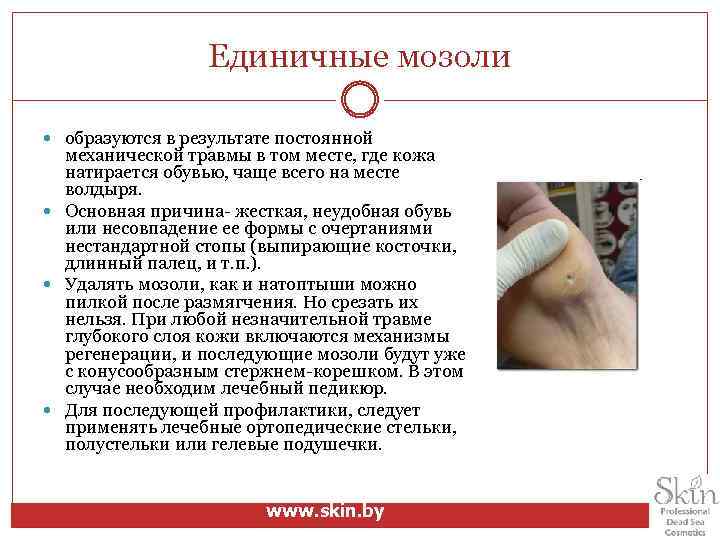 Единичные мозоли образуются в результате постоянной механической травмы в том месте, где кожа натирается