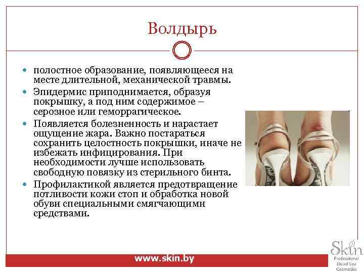 Волдырь полостное образование, появляющееся на месте длительной, механической травмы. Эпидермис приподнимается, образуя покрышку, а