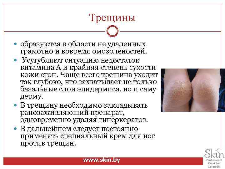 Трещины образуются в области не удаленных грамотно и вовремя омозоленостей. Усугубляют ситуацию недостаток витамина