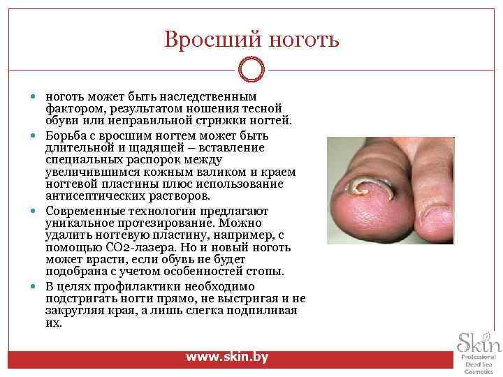 Вросший ноготь может быть наследственным фактором, результатом ношения тесной обуви или неправильной стрижки ногтей.