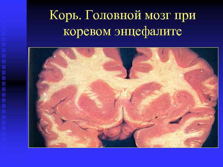 Корь. Головной мозг при коревом энцефалите 