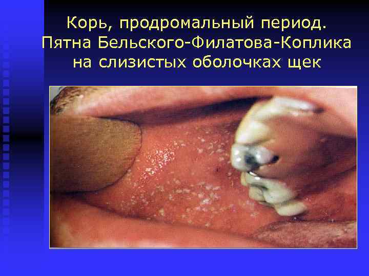 Корь, продромальный период. Пятна Бельского-Филатова-Коплика на слизистых оболочках щек 