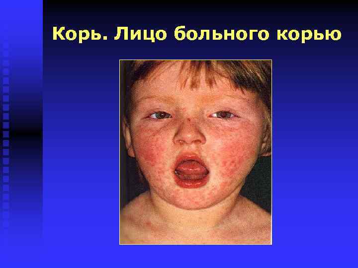 Корь. Лицо больного корью 