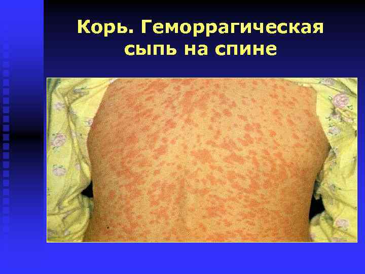 Корь. Геморрагическая сыпь на спине 
