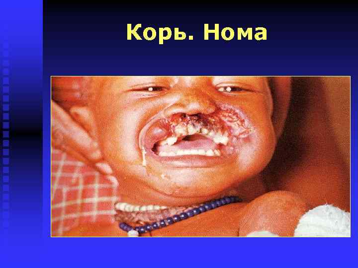 Корь. Нома 