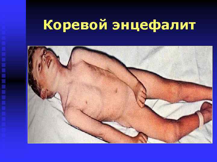 Коревой энцефалит 