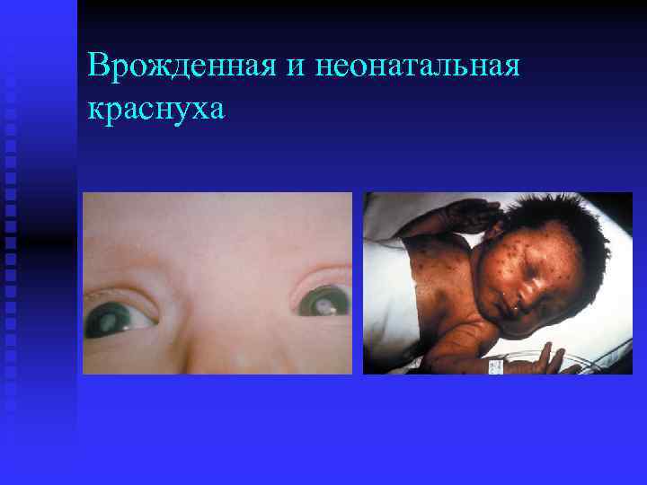 Врожденная и неонатальная краснуха 