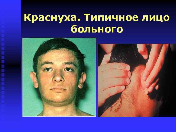 Краснуха. Типичное лицо больного 