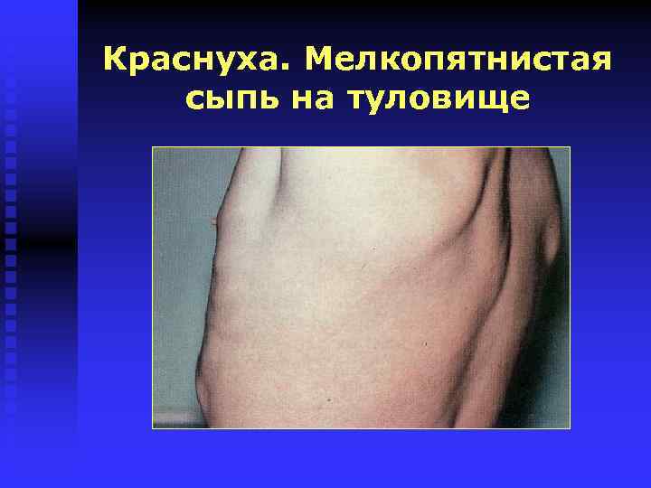 Краснуха. Мелкопятнистая сыпь на туловище 