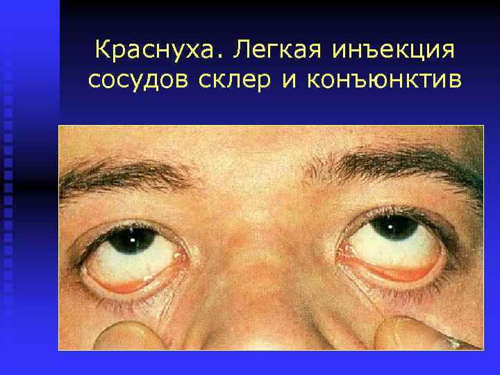 Краснуха. Легкая инъекция сосудов склер и конъюнктив 