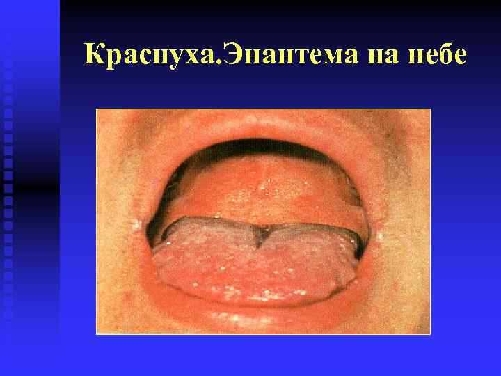 Краснуха. Энантема на небе 