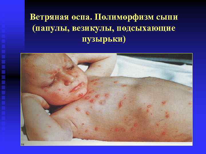 Ветряная оспа. Полиморфизм сыпи (папулы, везикулы, подсыхающие пузырьки) 
