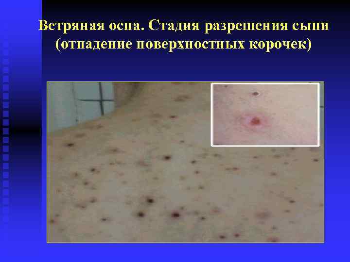 Ветряная оспа. Стадия разрешения сыпи (отпадение поверхностных корочек) 