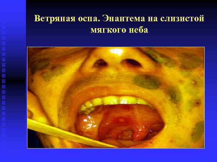 Ветряная оспа. Энантема на слизистой мягкого неба 