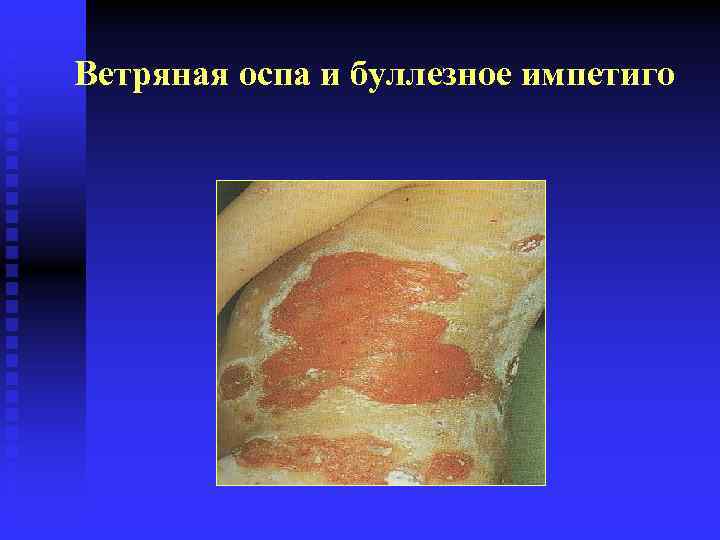 Ветряная оспа и буллезное импетиго 