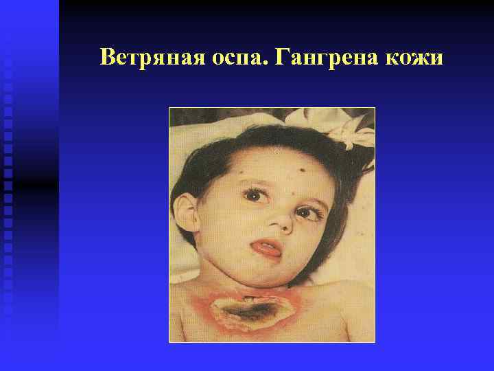 Ветряная оспа. Гангрена кожи 