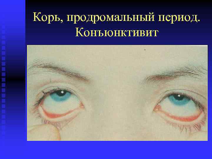 Корь, продромальный период. Конъюнктивит 