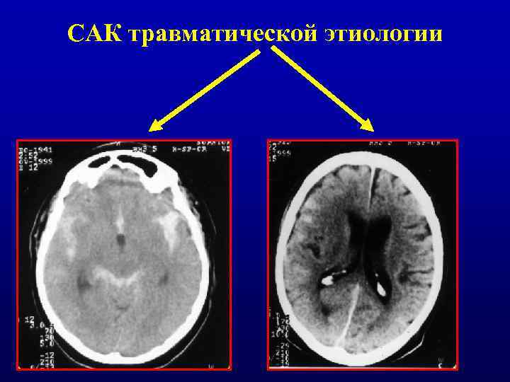 САК травматической этиологии 