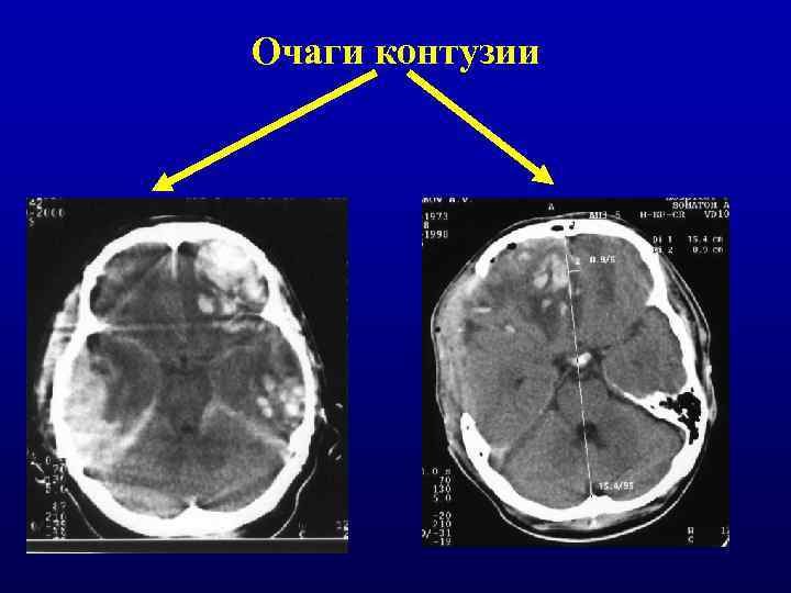 Очаги контузии 