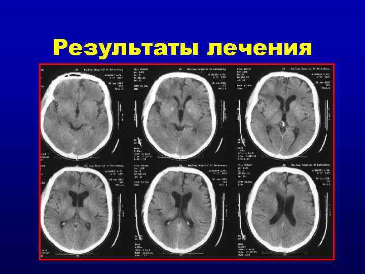 Результаты лечения 