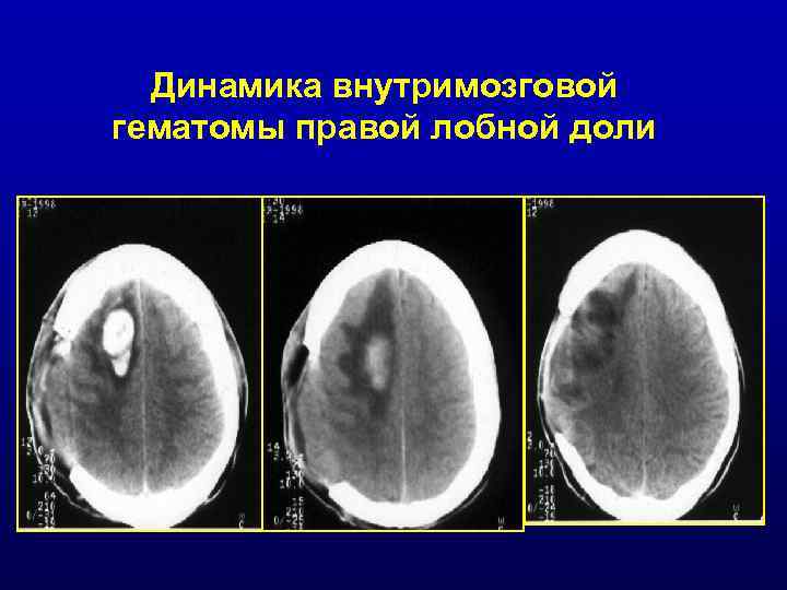 Динамика внутримозговой гематомы правой лобной доли 