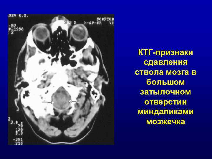 КТГ-признаки сдавления ствола мозга в большом затылочном отверстии миндаликами мозжечка 