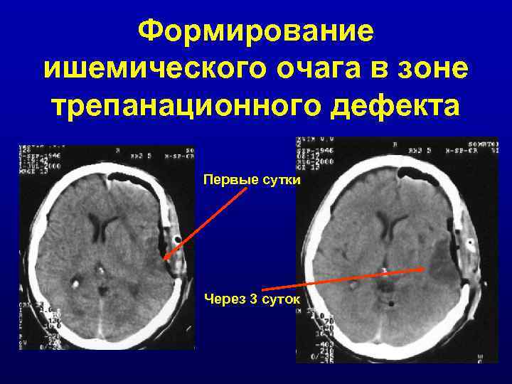 Формирование ишемического очага в зоне трепанационного дефекта Первые сутки Через 3 суток 