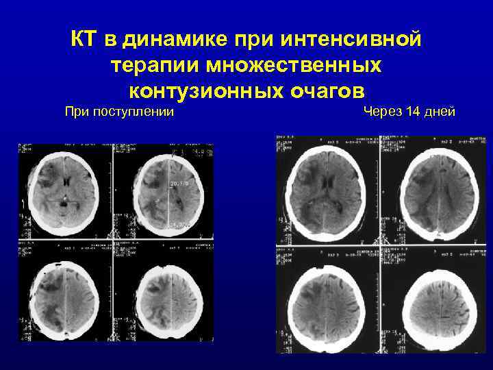 КТ в динамике при интенсивной терапии множественных контузионных очагов При поступлении Через 14 дней