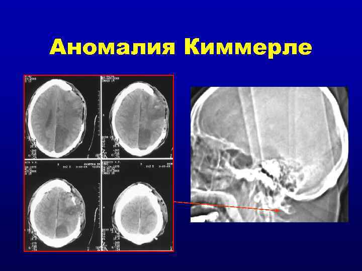 Аномалия Киммерле 